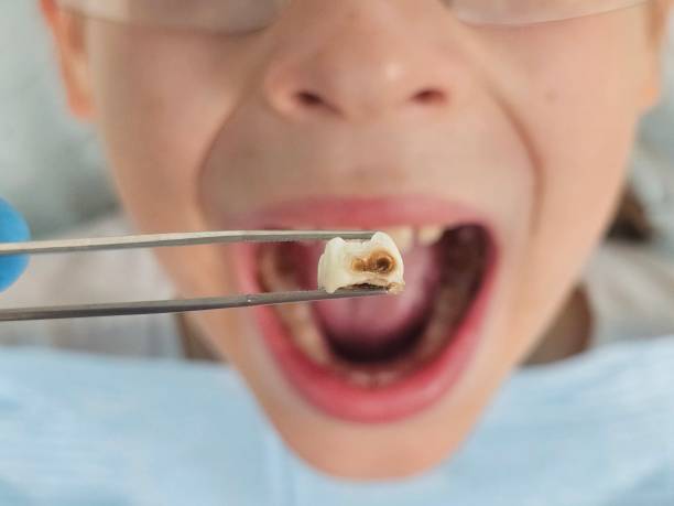 Best Knocked-Out Tooth Emergency  in Walker, LA